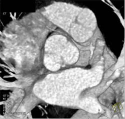 Right Coronary Artery Arises Off the LAD - CTisus CT Scan