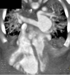 Small Left Pulmonary Artery - CTisus CT Scan