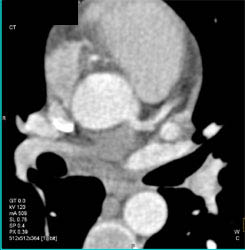 Plaque in LAD - CTisus CT Scan