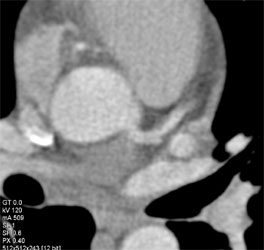 Plaque in LAD - CTisus CT Scan