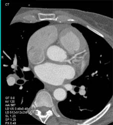 Plaque in LAD - CTisus CT Scan