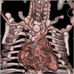 Pediatric CTA With Prominent Internal Mammary Arteries - CTisus CT Scan