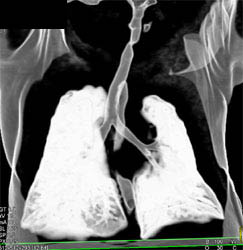 Tracheal Stenosis - CTisus CT Scan