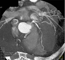 Diseased LAD - CTisus CT Scan