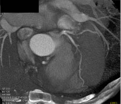 Diseased LAD - CTisus CT Scan