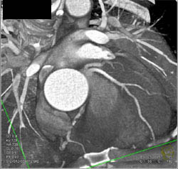 Diseased LAD - CTisus CT Scan