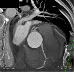 Diseased LAD - CTisus CT Scan