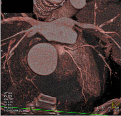 Diseased LAD - CTisus CT Scan