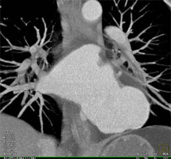 Dilated Aneurysm of Left Atrium - CTisus CT Scan