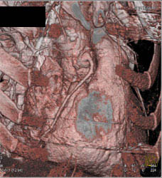 Normal RCA - CTisus CT Scan