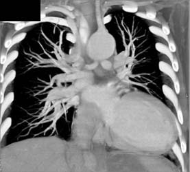 Aorta Gives Rise to LAD and Circumflex - CTisus CT Scan