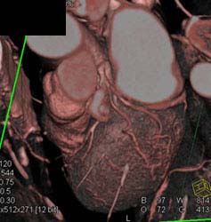 Normal LAD - CTisus CT Scan