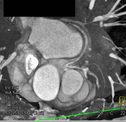 Normal Branching of Left Main Into LAD and Circumflex Artery (CX) - CTisus CT Scan