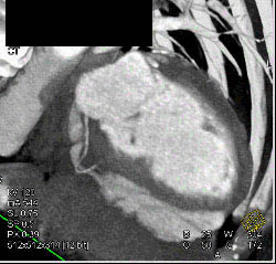 Normal RCA and Cardiac Vein - CTisus CT Scan