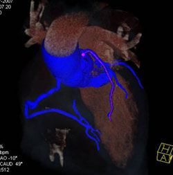 Normal Views of LAD - CTisus CT Scan