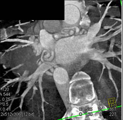 Coronary Artery Fistulae From Circumflex - CTisus CT Scan