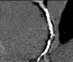 Disease RCA With Greater Than 50% Stenosis - CTisus CT Scan