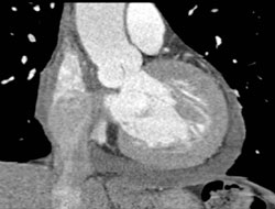 Pericardial Effusion - CTisus CT Scan