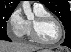 Pericardial Effusion - CTisus CT Scan