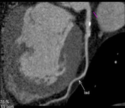 Multiple Vessel Disease With Range of Images - CTisus CT Scan