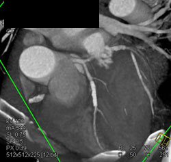 Stent in LAD That Is Patent - CTisus CT Scan