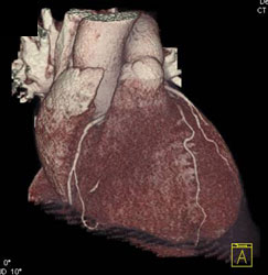 RCA Disease With Soft Plaque - CTisus CT Scan