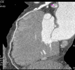 LAD Disease With Calcified and Soft Plaque - CTisus CT Scan