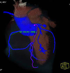 50% Stenosis LAD With Calcified and Non-calcified Plaque With Multiple Renderings - CTisus CT Scan