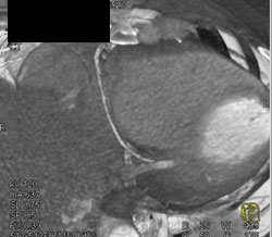 Normal RCA - CTisus CT Scan