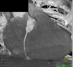 Normal RCA - CTisus CT Scan