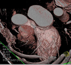 Good Example of Left Main Coronary Artery Branching Into LAD and Circumflex With LAD Disease - CTisus CT Scan