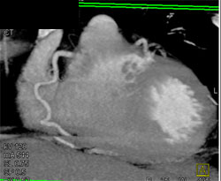 Artifact With Step Off RCA - CTisus CT Scan