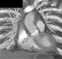 Multiple Views of Aortic Valve Replacement- Aortic Valve Replacement (AVR)- and Use of Optimal Imaging Phase - CTisus CT Scan