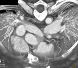 Dilated Left Pulmonary Artery - CTisus CT Scan