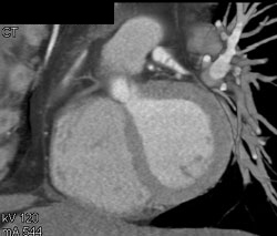 Normal LAD in Multiple Views - CTisus CT Scan