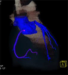 Normal RCA - CTisus CT Scan