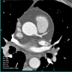 Normal Lca and RCA - CTisus CT Scan