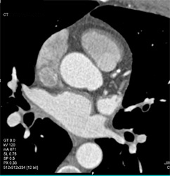 Normal LAD - CTisus CT Scan