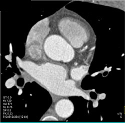 Normal LAD - CTisus CT Scan