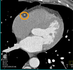 Soft Plaque RCA - CTisus CT Scan