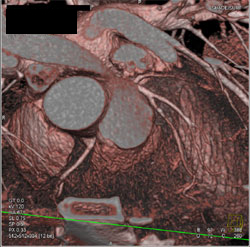 Diseased LAD - CTisus CT Scan