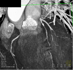 Diseased LAD - CTisus CT Scan