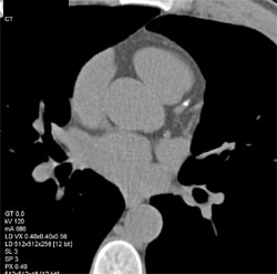 Diseased LAD - CTisus CT Scan