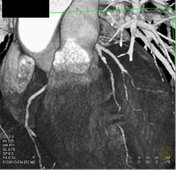 Diseased LAD - CTisus CT Scan