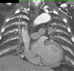 Patent Bypass Graft - CTisus CT Scan