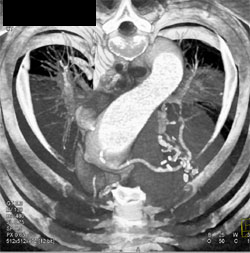 Patent Bypass Graft - CTisus CT Scan