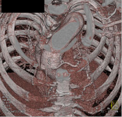 Patent Bypass Graft - CTisus CT Scan