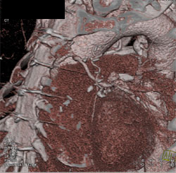 Patent Bypass Graft - CTisus CT Scan