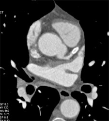 Patent Stent in LAD - CTisus CT Scan