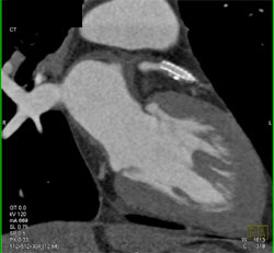 Patent Stent in LAD - CTisus CT Scan